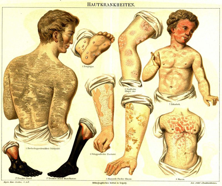 BỆNH VẢY CÁ (ICHTHYOSIS VULGARIS)