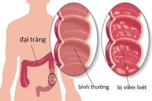 VIÊM ĐẠI TRÀNG - LỴ