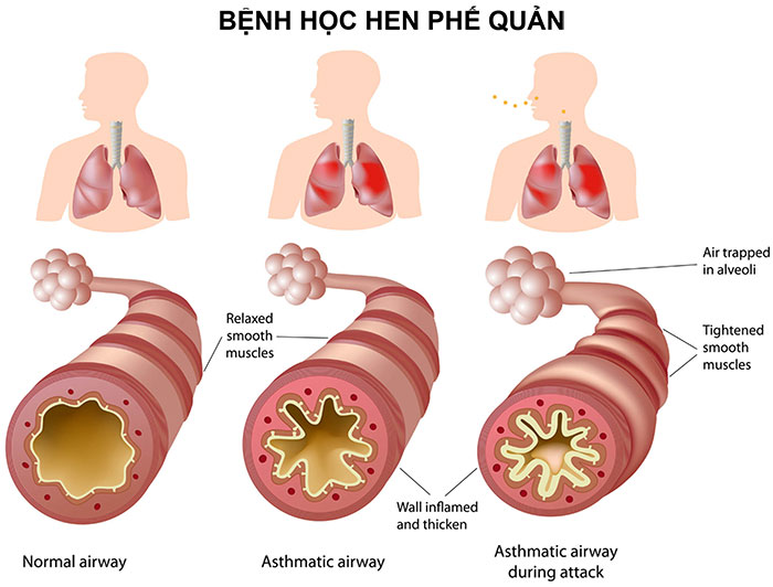 HEN SUYỄN