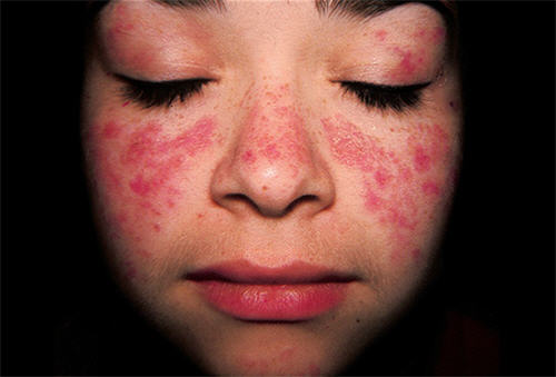 LUPUS BAN ĐỎ HỆ THỐNG