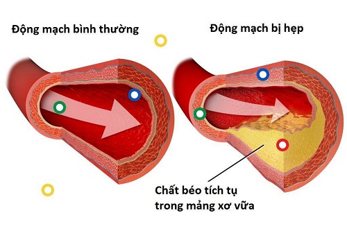 TẮC HẸP MẠCH VÀNH -  ĐỘT QUỴ