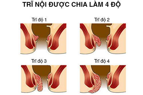 TRĨ NỘI - TRĨ NGOẠI - SA DÂY CHẰNG TỬ CUNG