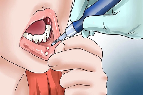 Bệnh Lở Miệng Lưỡi