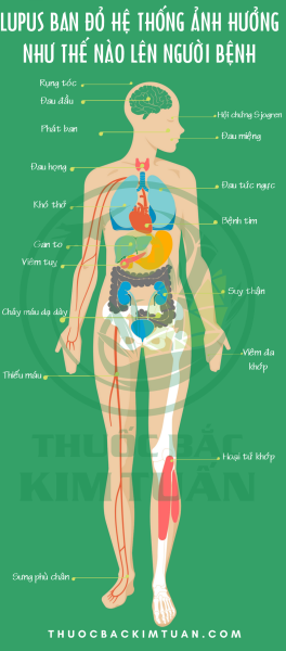 Lupus ban đỏ hệ thống ảnh hưởng như thế nào lên người bệnh