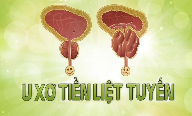 U Xơ Tiền Liệt Tuyến, Tiểu Không Hết, Giảm Sinh Lý