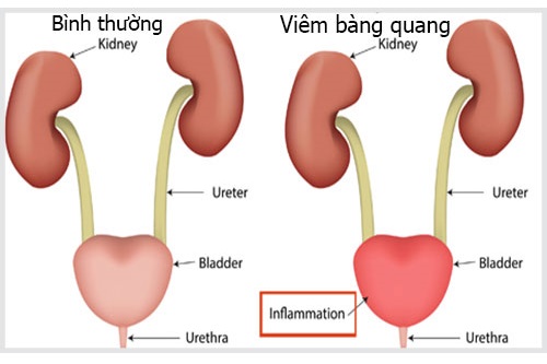 Viêm Bàng Quang, Viêm Đường Tiểu, Đái Dắt Buốt