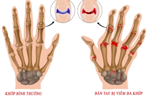 VIÊM ĐA KHỚP DẠNG THẤP