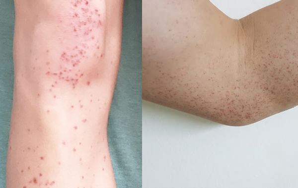 VIÊM MAO MẠCH DỊ ỨNG XUẤT HUYẾT