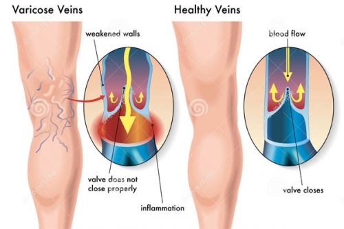 VIÊM TẮC TĨNH MẠCH - SUY VAN TĨNH MẠCH - PHÙ CHÂN